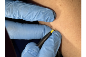 How Many Electrolysis Sessions Do You Actually Need?