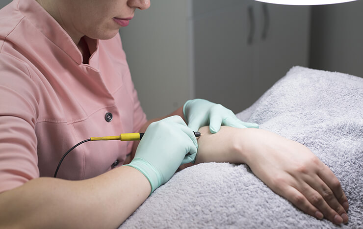 Comapre Electrolysis vs. Laser Hair Removal | Nios Spa