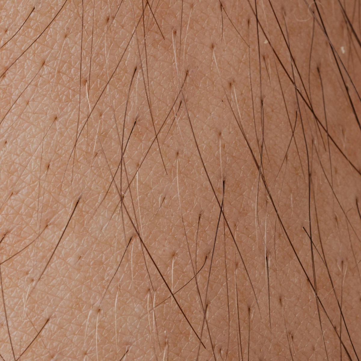 Close-up of excessive hair growth hirsutism and hypertrichosis