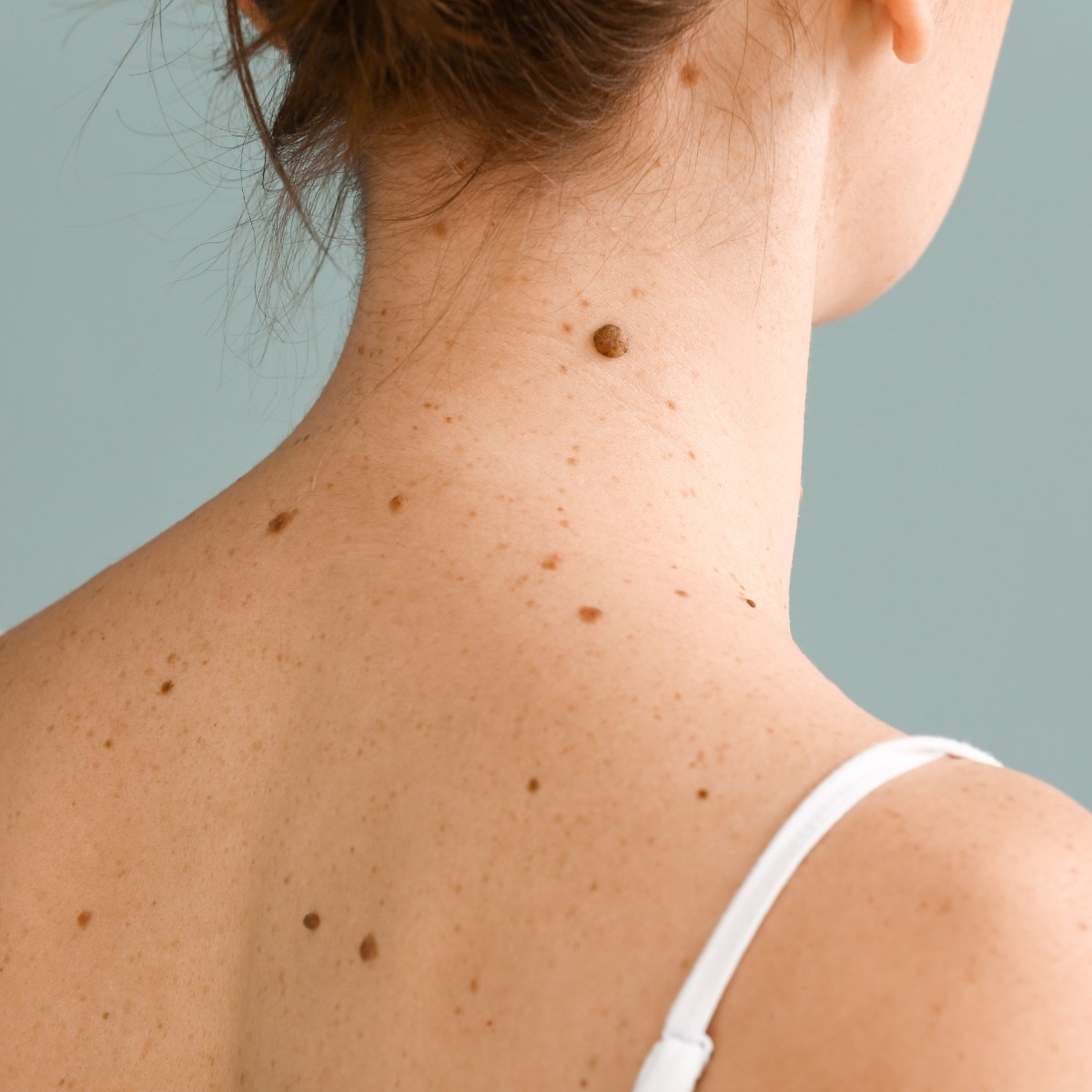 Permanent mole hair removal NYC with electrolysis
