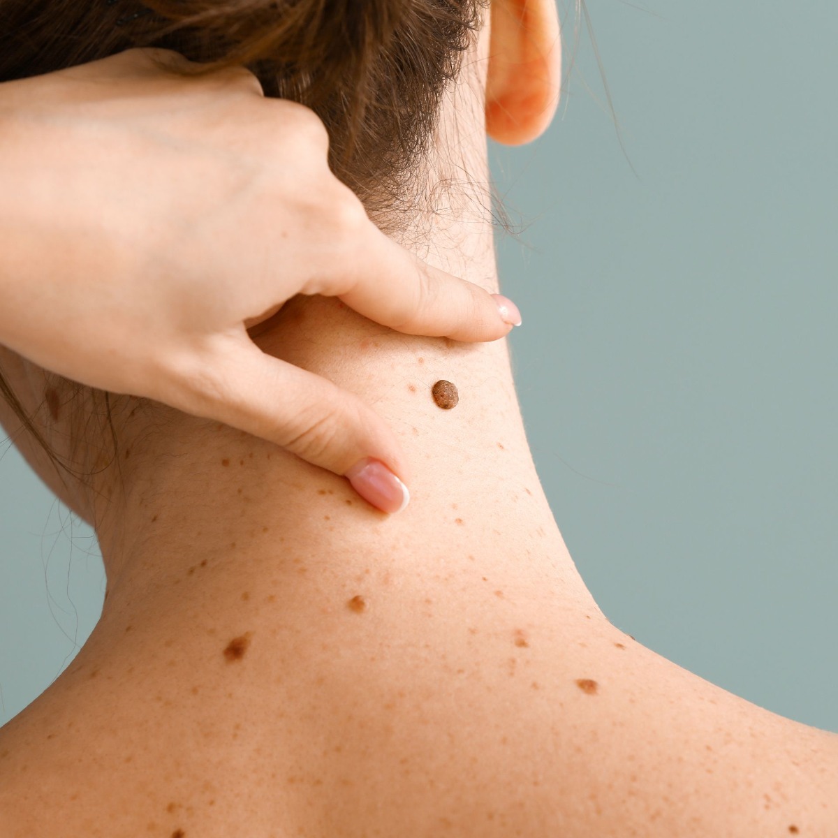 Professional mole hair removal treatment results at Nios Spa NYC