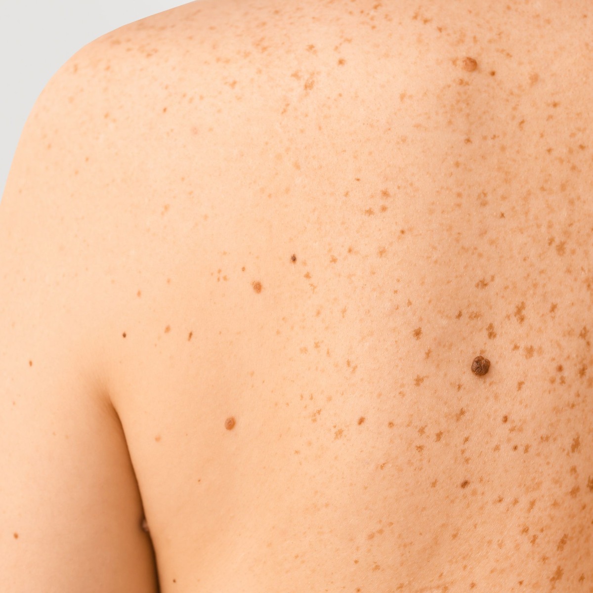 Confident after electrolysis for mole hair in nyc