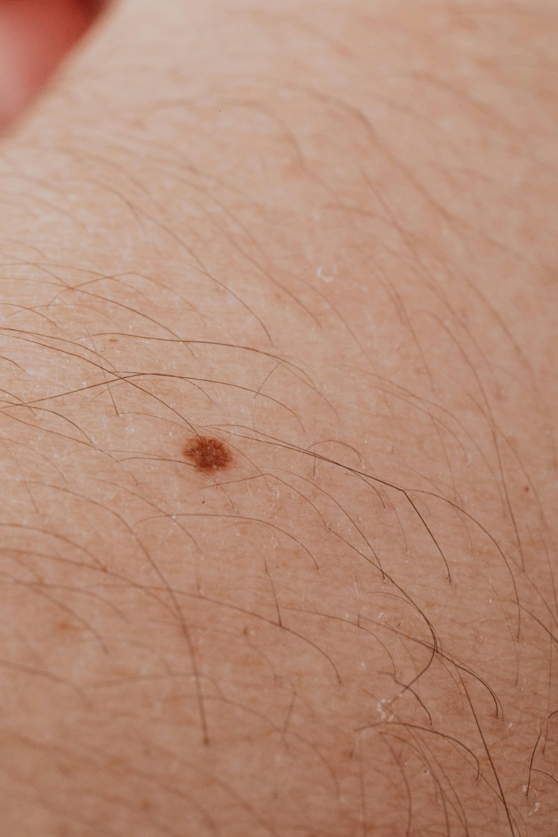 electrolysis permanent mole hair removal in NYC for smooth skin